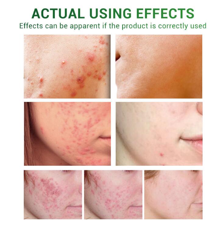 Before and after effects of a skincare product on skin with acne.